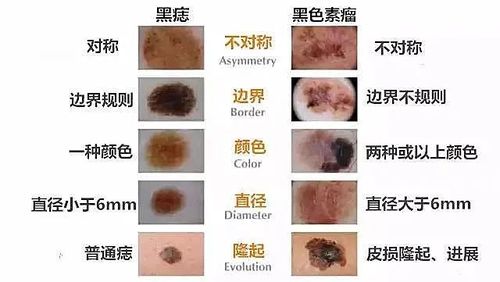 什么痣不能去除