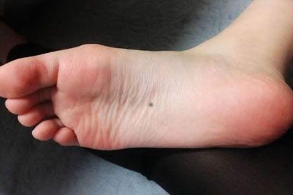 脚底长痣的女人命运如何