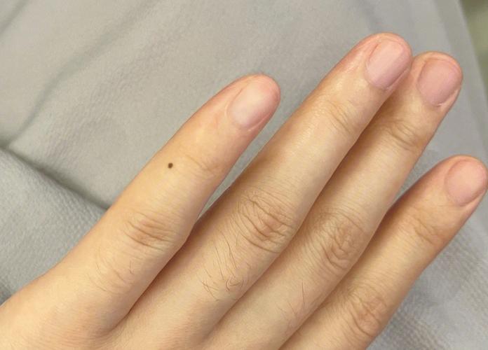 女人手上长痣怎么回事