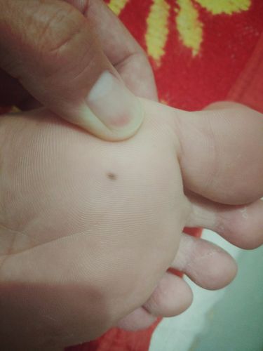 脚掌心有一颗痣