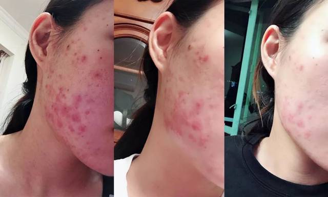 梦到自己给自己挤脓包是什么意思