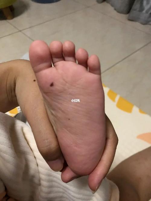 小孩脚底有痣好不好