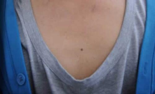 男人胸上面长痣,寓意“空怀大志”?