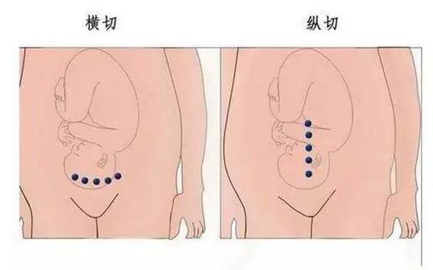 剖腹产的八字怎么算?