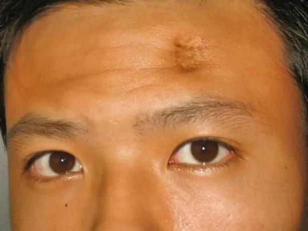 男人脸上有疤会影响霸气吗