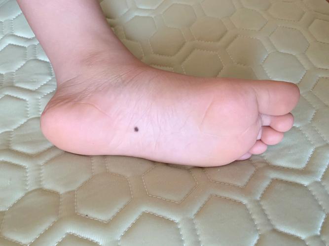 脚底有痣的女性都有什么说法?痣的颜色怎么看吉凶?