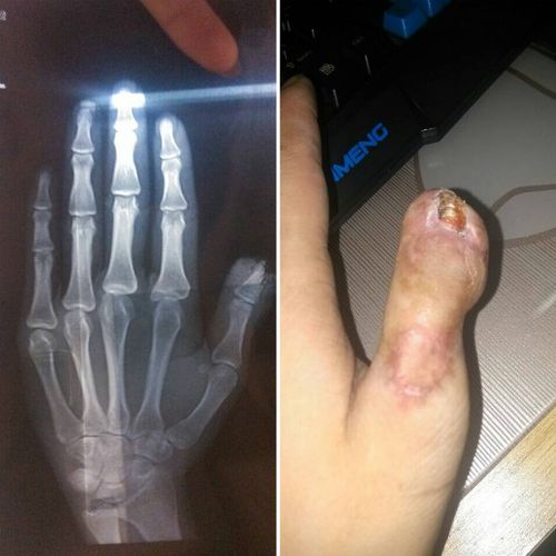 梦见大拇指断了