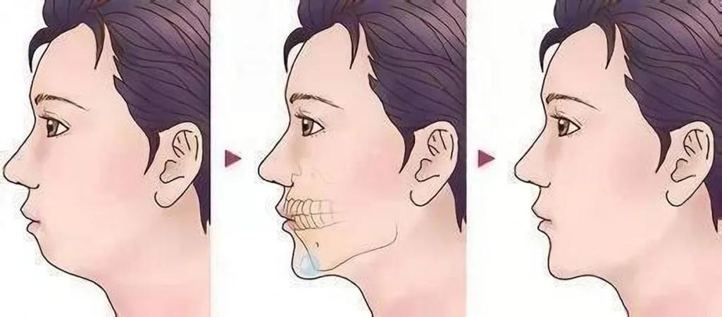面相图解:下巴短小是好是坏?
