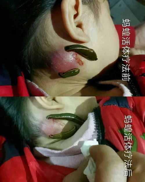 梦见蚂蝗吸血被拿掉是什么意思