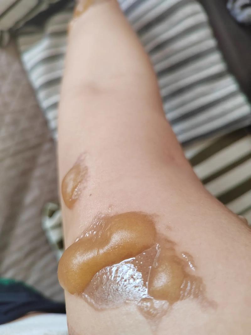 梦见疮疤