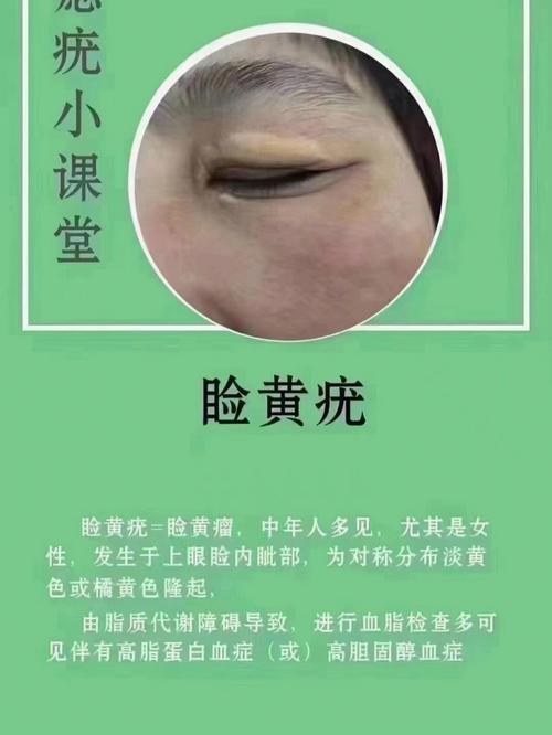 点痣后运气变了是真的吗