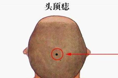 头皮上有痣的男人一生的运势如何