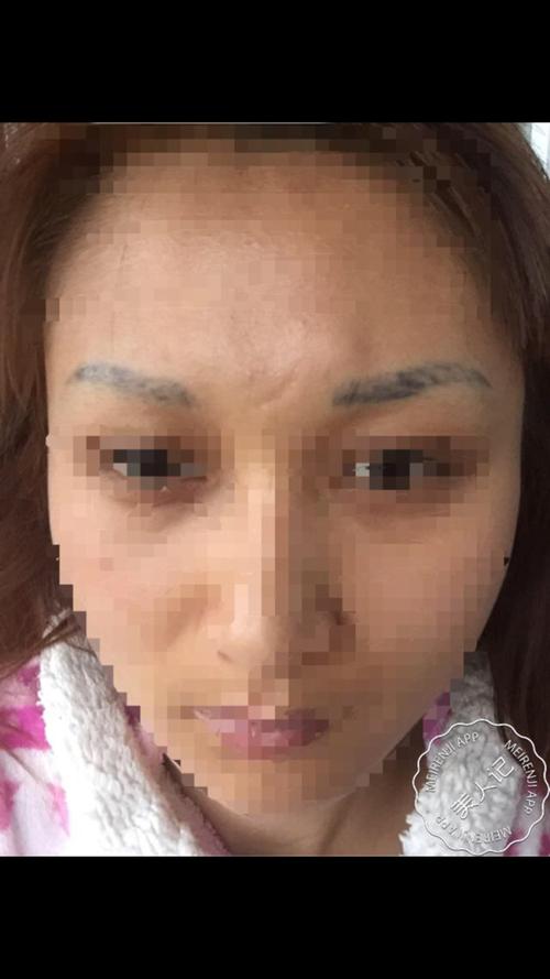 女人脸部:命宫上有疤痕好不好