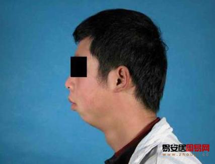 没下巴面相是怎样的