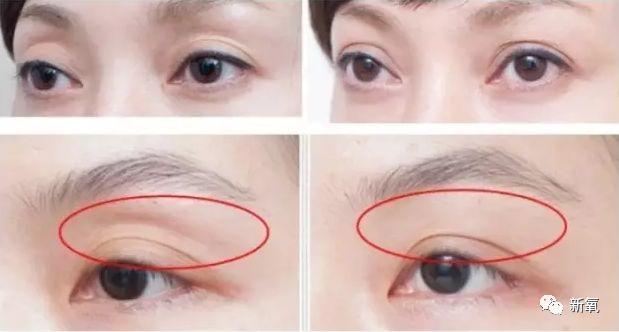 为什么眼窝凹陷且发黑,眼窝凹陷面相好吗