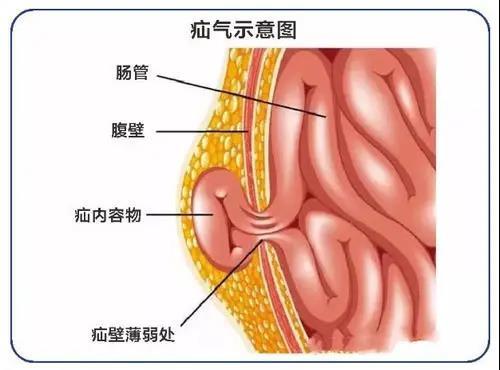 梦见疝带周公解梦,梦见疝带是什么意思?