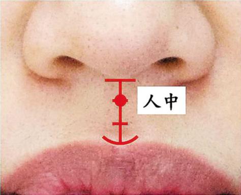 人中无沟是好还是坏