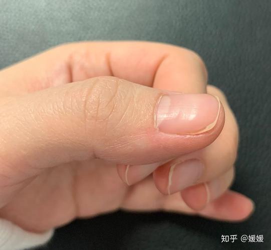 手指出现横纹怎么回事