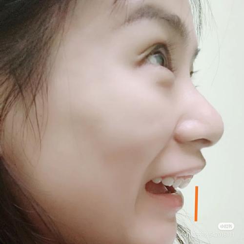 什么是内倾牙,内倾牙好吗?