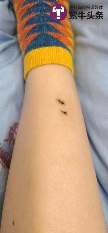 女人梦到被蛇咬到腿