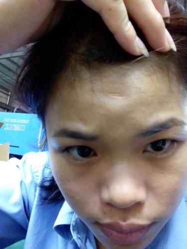 女人额头有疤痕的面相