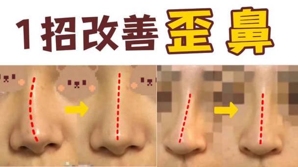 歪鼻子会影响事业运势吗