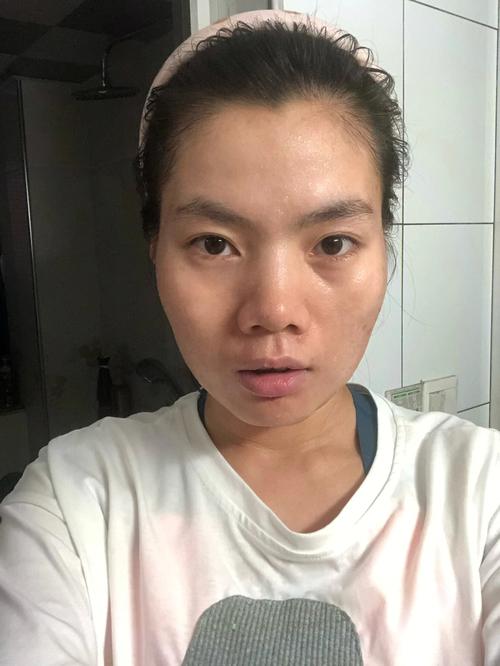 太阳穴下凹好不好