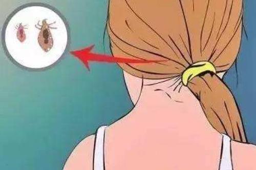 女人梦见头上长虱子