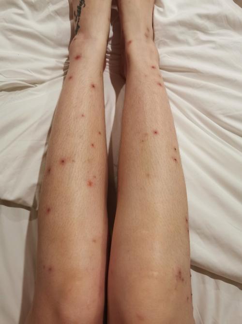 梦见蚊子咬是什么意思