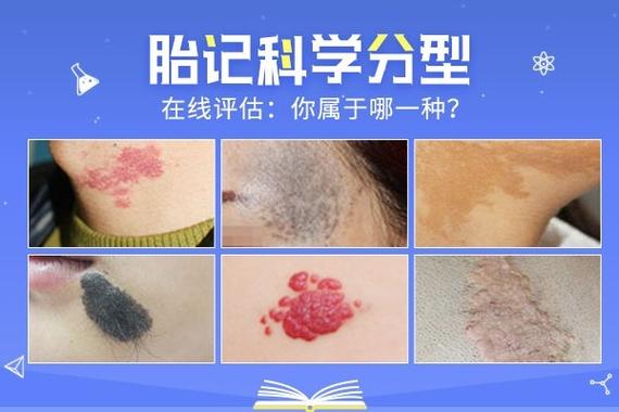 胎记有哪些颜色和类型