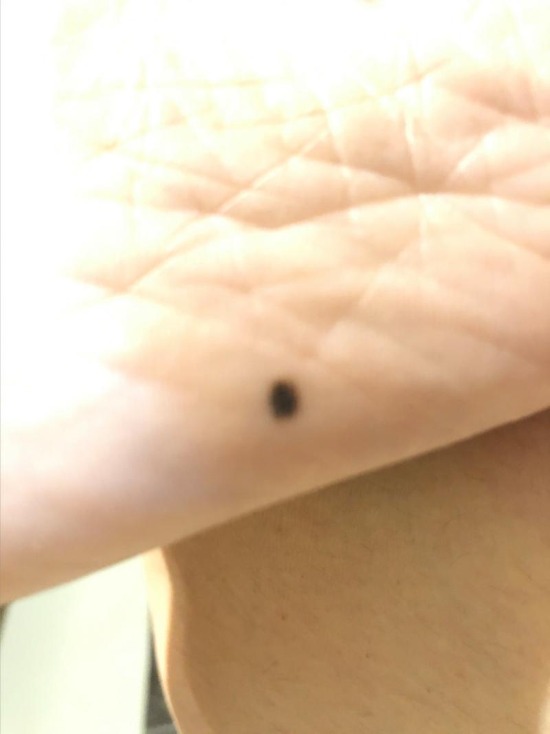 脚底板突然长了颗黑痣有什么兆头?