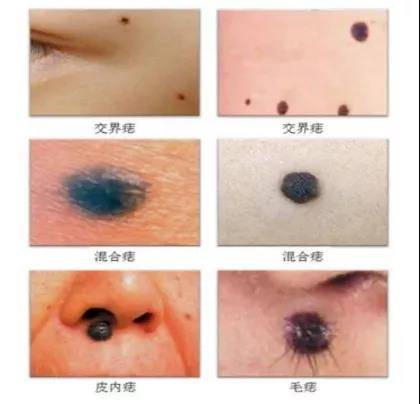 痣的准确性有多高