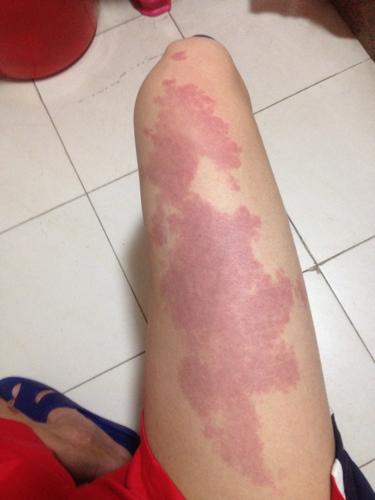 腿部胎记的位置与命运分析