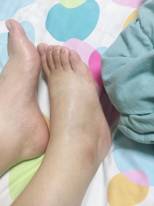 梦见脚肿