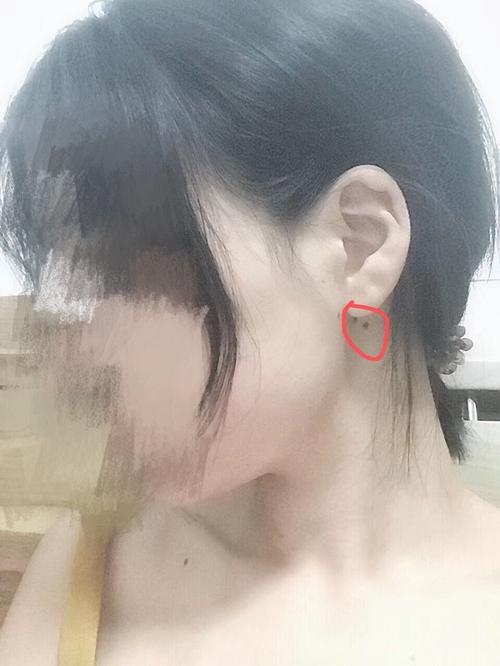 女人耳垂背后有痣代表什么