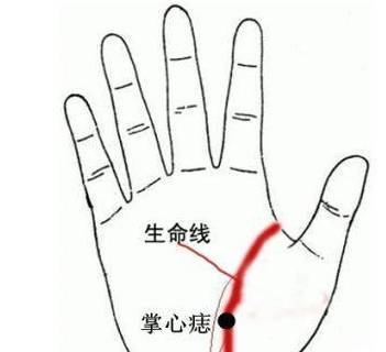 掌中握痣有说道