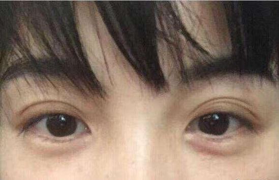 观赏眼皮可知你的情感状况
