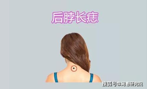 后脖子头发里有痣