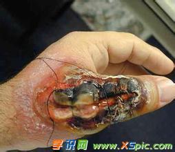梦见自己手被蜘蛛咬了预示什么