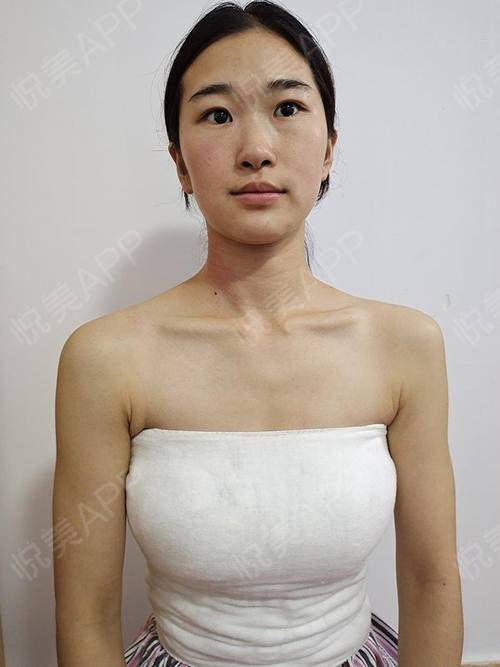 梦见自己隆胸是什么意思