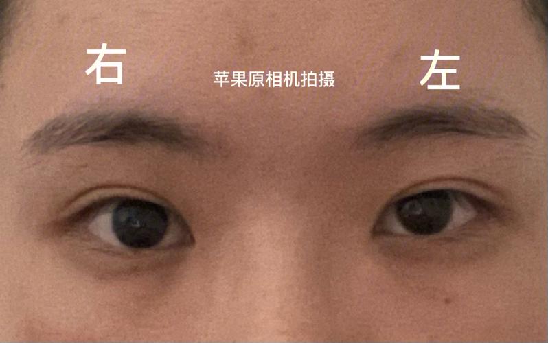 割双眼皮会改变面相吗