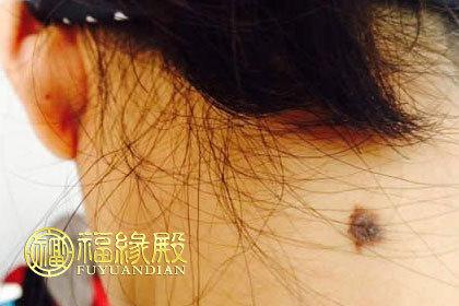 后颈的痣是压运痣吗