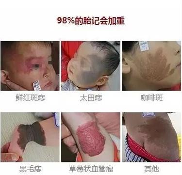 如何从自己身上的胎记中看出未来的命运以及性格?