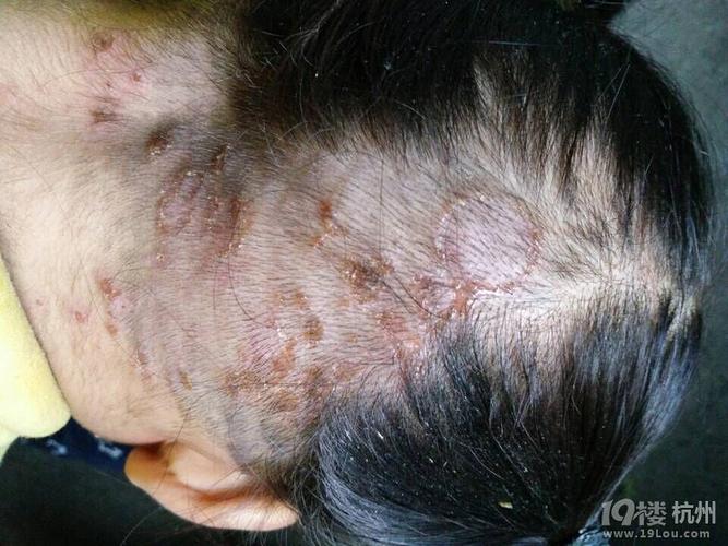 梦见脸上长疮是什么意思