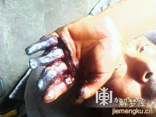 梦见自己在事故中受伤了