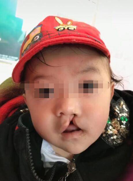 兔唇之人的命 兔唇的人命运不好