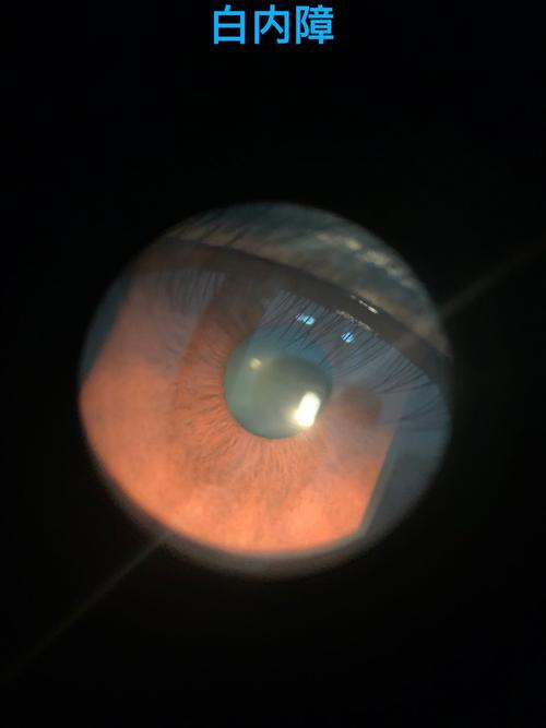 梦见眼疾