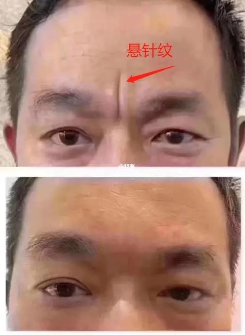 印堂的皱纹是善纹吗?影响如何呢
