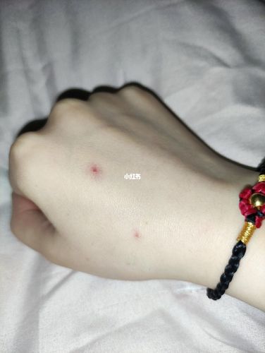 手背的朱砂痣是什么意思