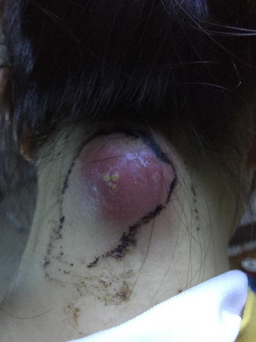梦见脖子长脓疱